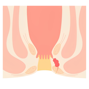 Ano-Rectal Pain in Hyderabad
