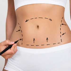 Liposuction Surgery in Hyderabad 