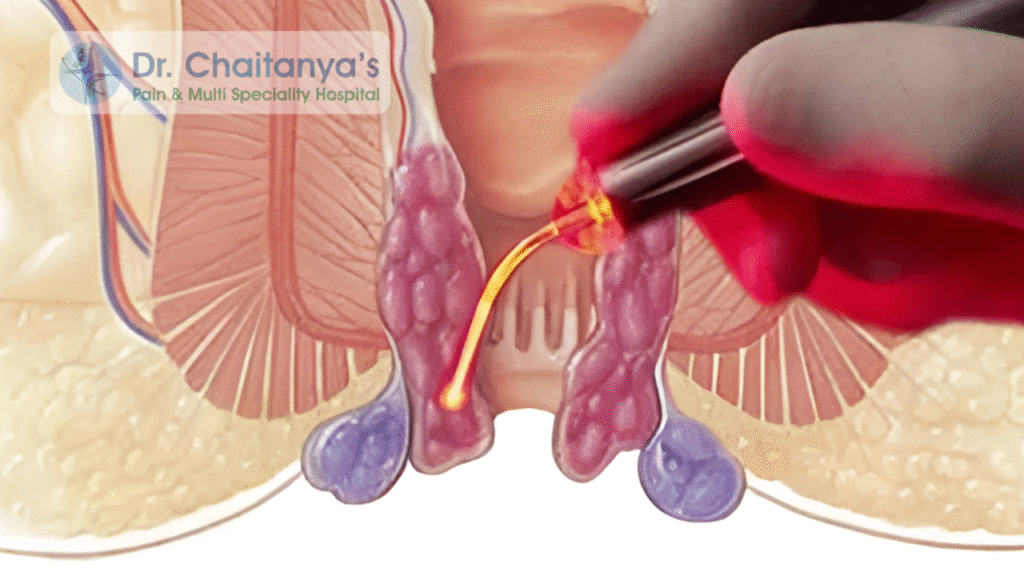 Best laser surgery center for piles and fissures